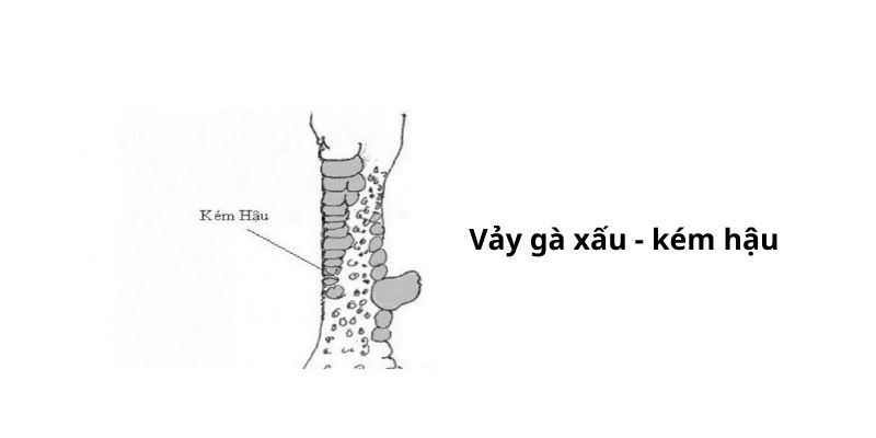 Vảy kém hậu